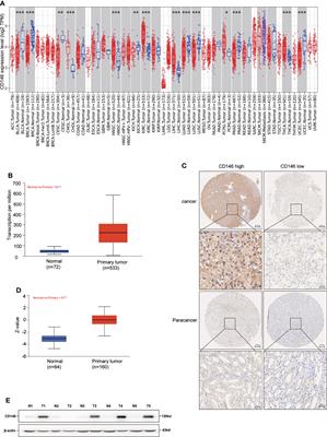 CD146 as a Prognostic-Related Biomarker in ccRCC Correlating With Immune Infiltrates